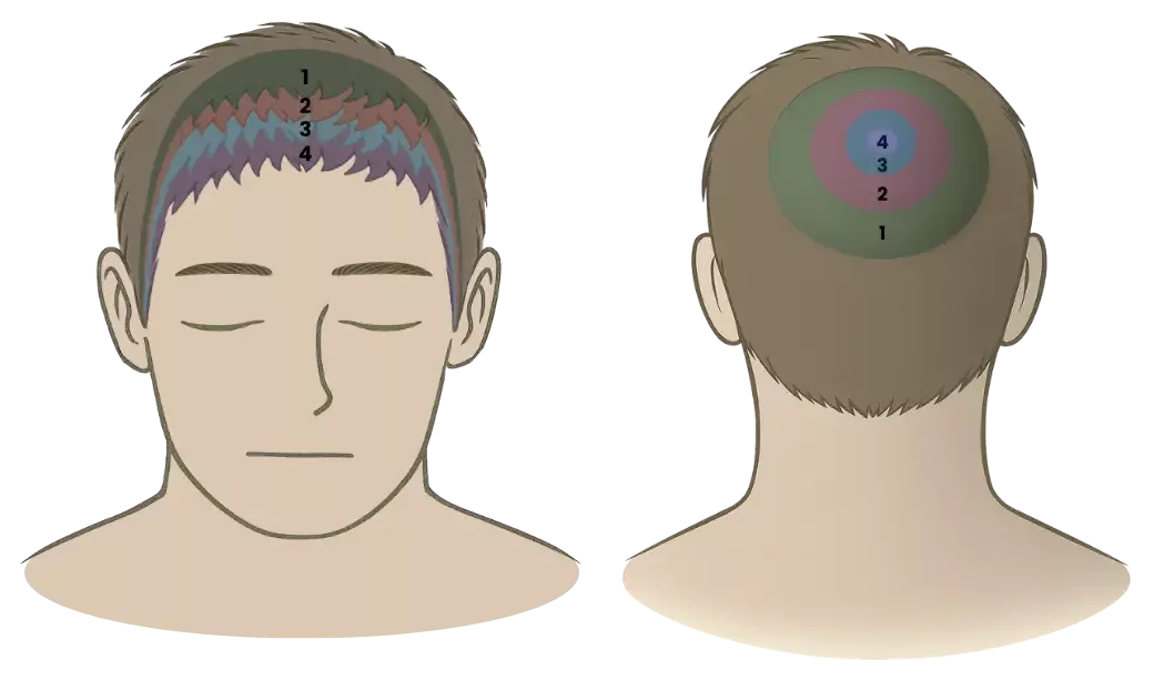 Hairline 1