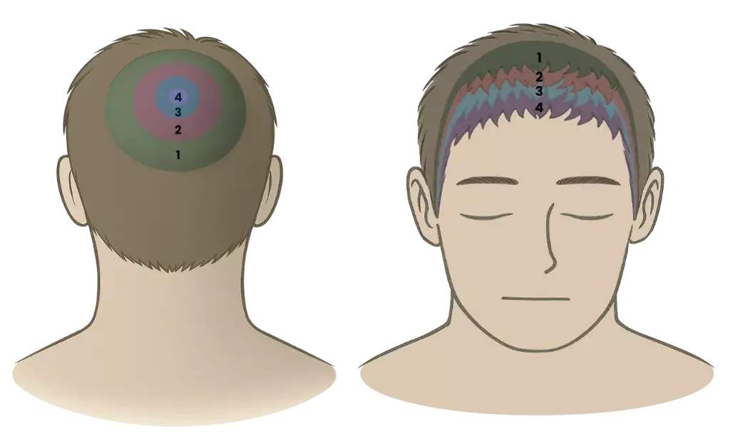Hairline AR1