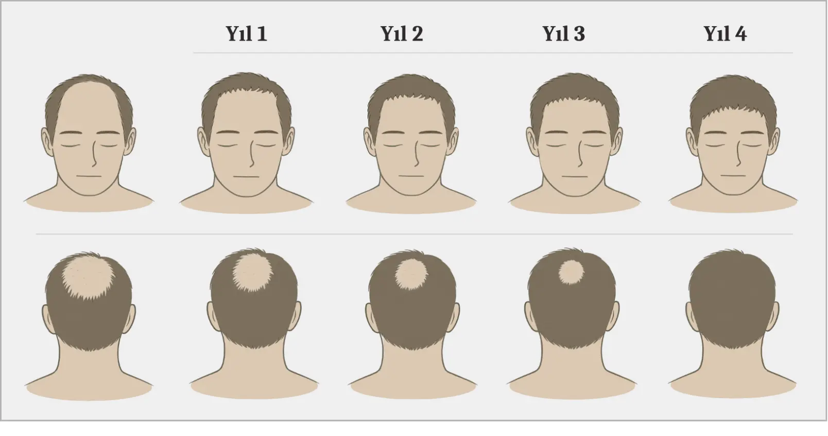 Hairline TR2